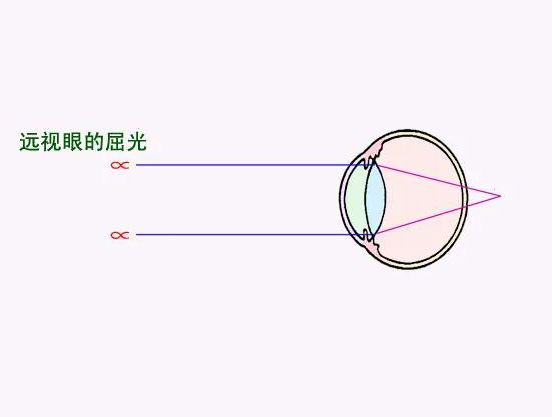 孩子远视正常吗？一文揭秘远视眼是怎么回事？